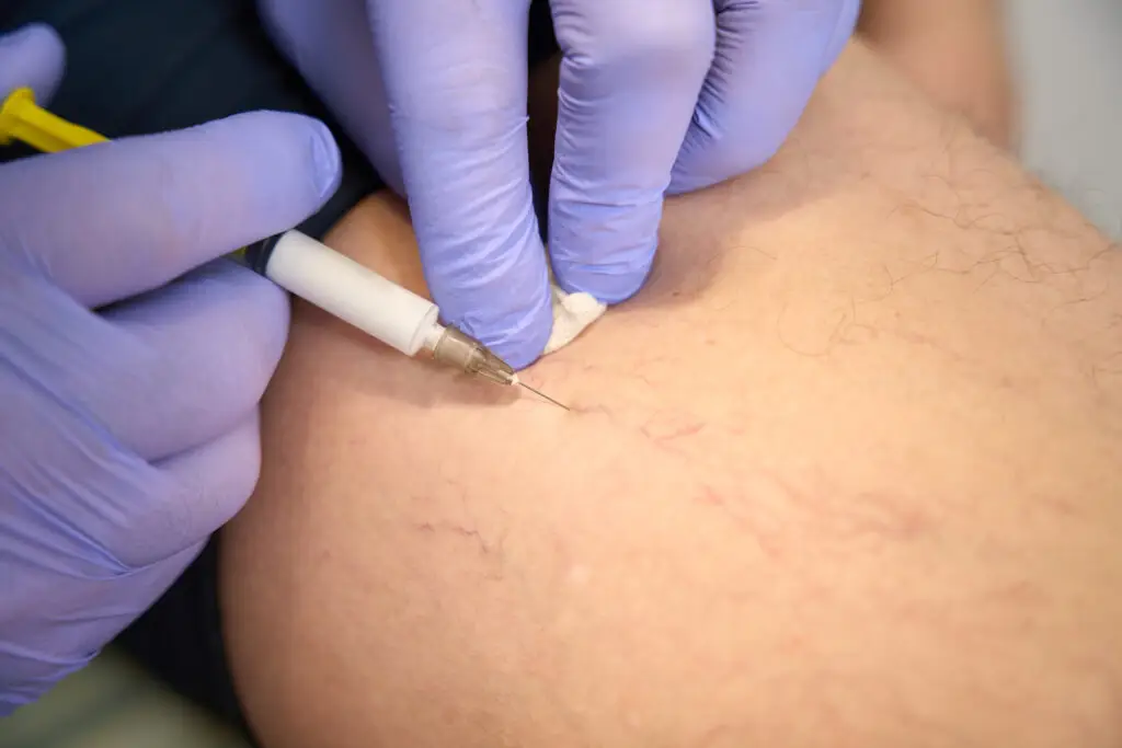 Sclerotherapy
